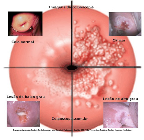 Resultado de imagem para cancer do colo do utero fotos reais